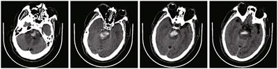 Curative effect analysis of robot-assisted drainage surgery in treatment of spontaneous hypertensive brainstem hemorrhage